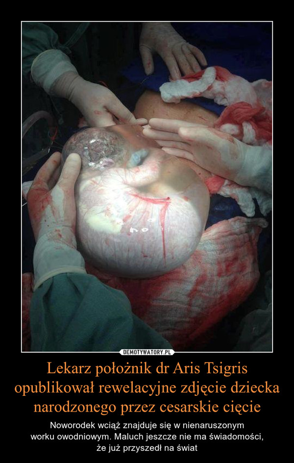 Lekarz położnik dr Aris Tsigris opublikował rewelacyjne zdjęcie dziecka narodzonego przez cesarskie cięcie
