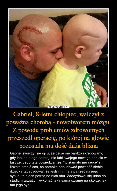 Gabriel, 8-letni chłopiec, walczył z poważną chorobą - nowotworem mózgu. Z powodu problemów zdrowotnych przeszedł operację, po której na głowie pozostała mu dość duża blizna